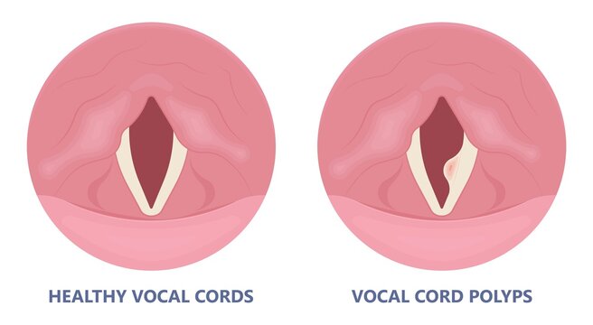 Vocal Cords Images – Browse 24,809 Stock Photos, Vectors, and Video | Adobe  Stock