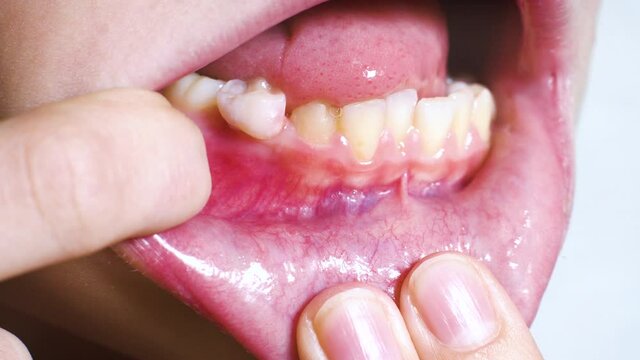 Child keeping mouth open with fingers and shaking baby tooth with tongue. Extreme closeup of changing lower teeth. Concept of dental care