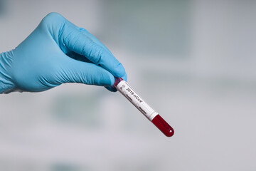hand in blue gloves holding a coronavirus blood test tube in front of a lab room 