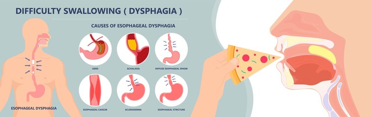 Dysphagia infection trachea examine Surgery choking gastric diagnose windpipe disorder bleeding surgical GERD treat tumor throat biopsy system ulcers stomach block eat food stuck test tract stent pain