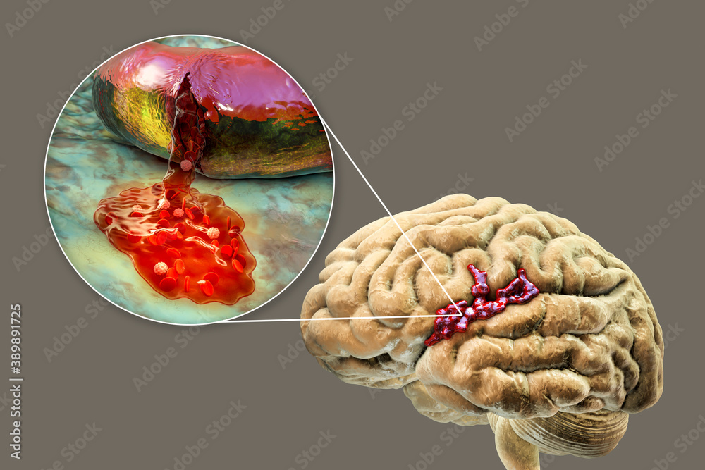 Wall mural Hemorrhagic stroke, illustration