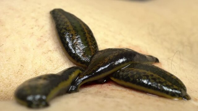 Medical leeches on the human body drink blood. Treatment with leeches. Macro video.