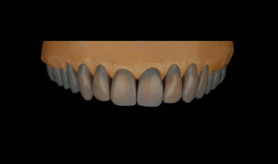 dental wax-up design on black background