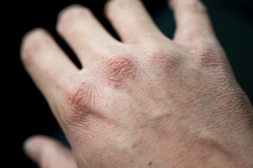 Macro picture of a hand with wounds damaged by the cold and the use of hydroalcoholic gels