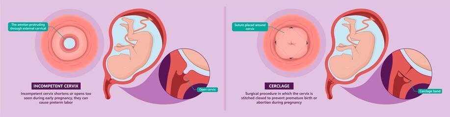 Incompetent cervix cervical insufficiency weak tissue premature stitch preterm miscarriage recurrent 