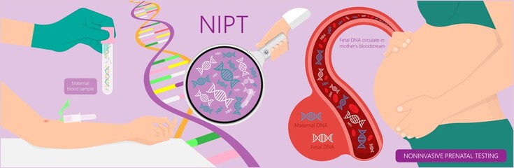 Noninvasive prenatal testing NIPT screening genetic disorders bloodstream cfDNA lab plus diagnostic diagnose 21 18 13 cell free chromosomal NIFTY exam simple pregnancy - obrazy, fototapety, plakaty
