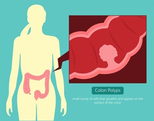 Polypectomy procedure to remove polyps from the colon medical
