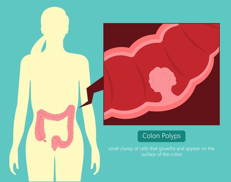 Polypectomy Procedure To Remove Polyps From The Colon Medical