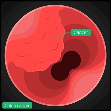 Polypectomy procedure to remove polyps from the colon medical