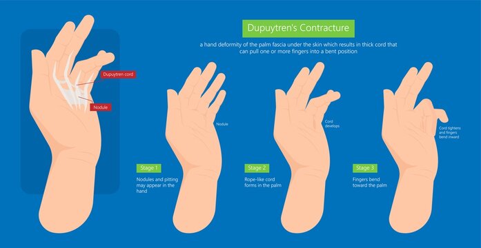 Dupuytren's contracture palm tissue disease