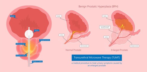 Benign prostate enlargement Prostatitis of BPH the UTI exam flow pain tube TUMT TURP Acute block fluid gland penis sperm tract treat urine benign cancer pelvic system