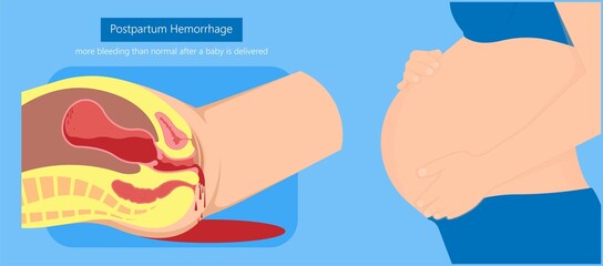 Postpartum hemorrhage PPH care baby loss Prevent therapy problem vagina period Lochia mother uterus trauma previa atony labor blood women birth treat Risk