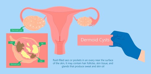 Ovarian Dermoid cysts symptoms of uterus cancer