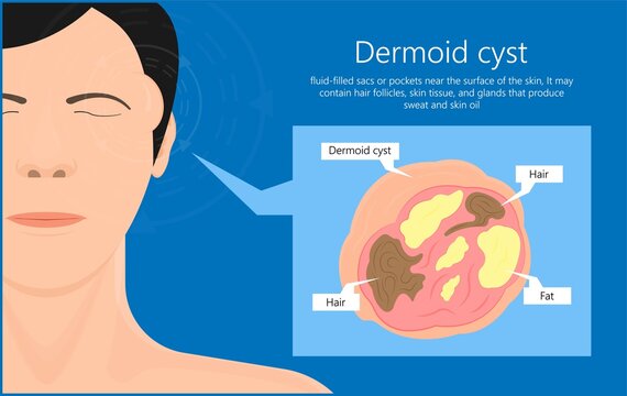 Dermoid cysts symptoms on patient face