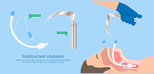 Endotracheal intubation ICU care unit COVID 19 larynx  throat rescue surgery mouth Tube trachea breathe ventilation deliver oxygen lungs insert sedate rest airway foreign body removal block aspiration - obrazy, fototapety, plakaty