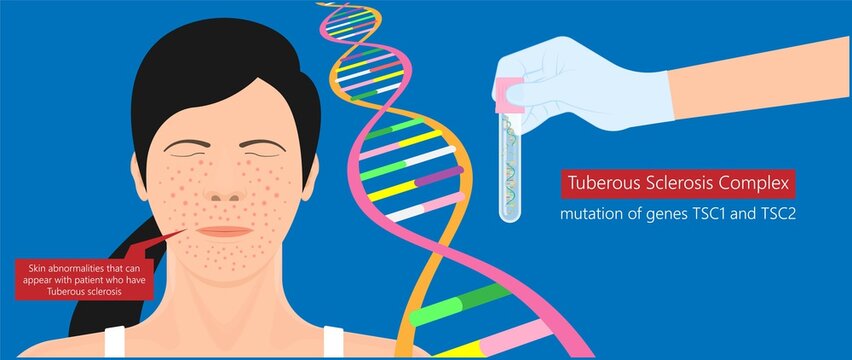 Tuberous Sclerosis Complex genetic disease symptoms aka Bourneville polycystic kidney