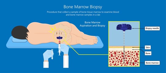 Bone biopsy medical marrow harvest stem cell transplants aspiration specimen cancer procedure sample test treatment diagnosis anemia blood cell lab disorder - obrazy, fototapety, plakaty