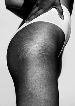 Stretch marks
