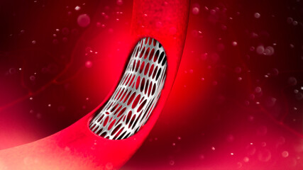 Coronary artery bypass surgery, is a surgical procedure to restore normal blood flow to an obstructed coronary artery. Angioplasty. Narrowing of a vein Formation of cholesterol, fats.