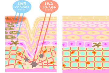 紫外線による肌ダメージイラストと正常な肌断面図
