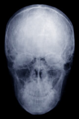 the man's skull. x-ray.