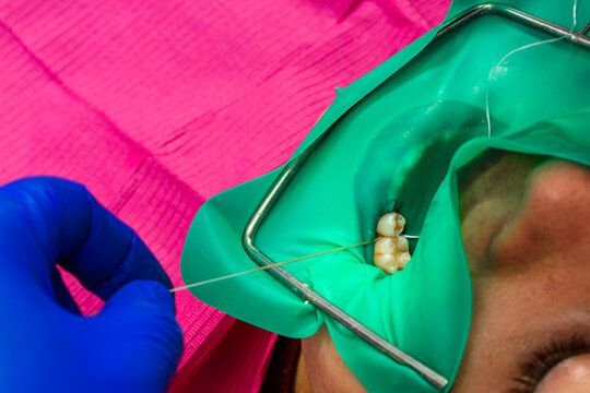 Installation of a cofferdam to the patient, modern dental equipment, treatment in sterile conditions.