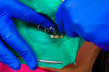 The dentist treats the patient's tooth with a rubber dam, drill, mirror.