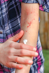 a wounds atepic dermatitis in the hands of a child