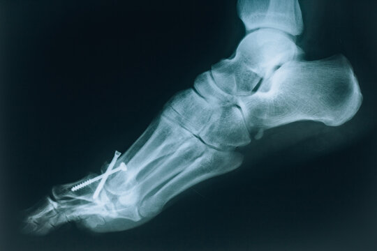 X-ray of a human foot. Human bones, leg injury