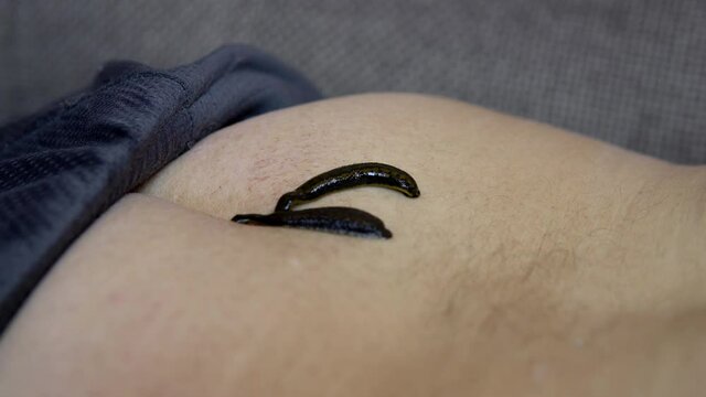 The man has leeches on his thigh. Treatment procedures with leeches