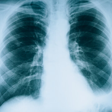 X-ray of lungs. Fluorography. Checking for respiratory diseases