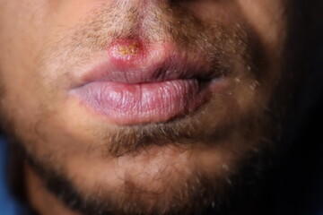 Herpes Simplex Virus (HSV) Mouth Infection.
herpes simplex virus type 1.
herpes simplex...