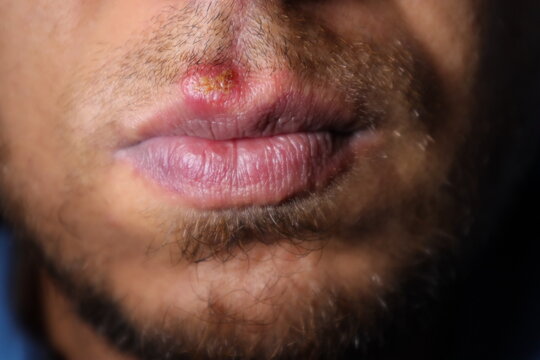 Herpes Simplex Virus (HSV) Mouth Infection.
herpes simplex virus type 1.
herpes simplex labialis.
fever, infectious disease. 
Herpes labialis.
cold sores.
Human alphaherpesvirus 1.
viral infections