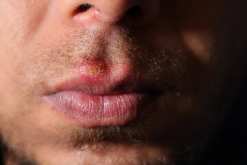 Herpes Simplex Virus (HSV) Mouth Infection. herpes simplex virus type 1. herpes simplex labialis. fever, infectious disease. Herpes labialis. cold sores. Human alphaherpesvirus 1. viral infections	 - obrazy, fototapety, plakaty