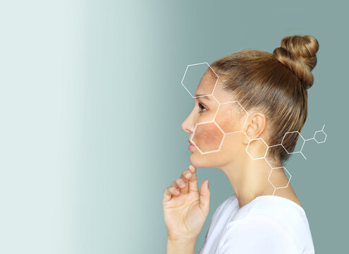 Dark spots, freckles,hyperpigmentation(melasma or chloasma).