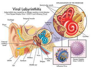 Medical illustration showing an inflammation of the inner ear from viral labyrinthitis, caused by herpes simplex virus 1, and influenza virus, with anatomy of the ear and annotations. - obrazy, fototapety, plakaty