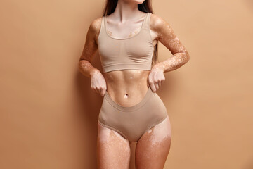 Vitiligo affected woman in beige cropped top and panties demonstrates flat stomach being not like others. Dermatology and skin condition concept