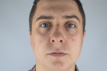 Fototapeta premium Acne close-up. A woman is being examined by a doctor. Dermatologist examines the skin through a magnifier, a magnifying glass