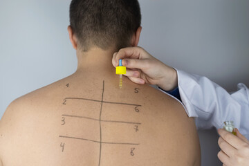 An allergist in the laboratory conducts an allergy prick-test. Skin test for household, food, epidermal allergic reactions. The test is performed on the patient's back