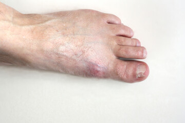 Male foot with nail fungus and inflamed gout. White background. There is room for text.
