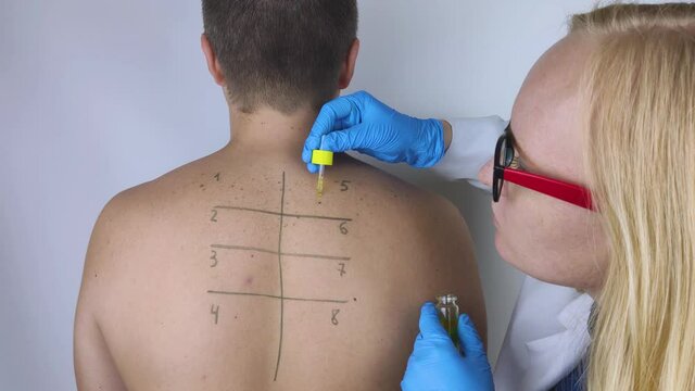 An allergist in the laboratory conducts an allergy prick-test. Skin test for household, food, epidermal allergic reactions. The test is performed on the patient's back