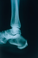 X-ray of the heel bones. Foot medical picture