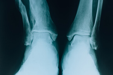 X-ray of the leg bones. Leg injury