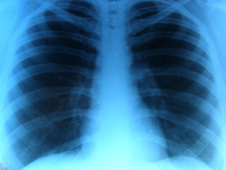 X-ray of the lungs, snapshot, coronavirus (covid - 19). Pneumonia. World pandemic.