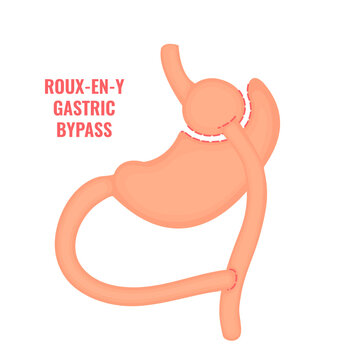 Roux-en-y Gastric Bypass. Bariatric Surgery Weight Loss Procedure. Stomach Reduction Anatomical Diagram Infographic. Health Care  Medical Concept. Vector Illustration.