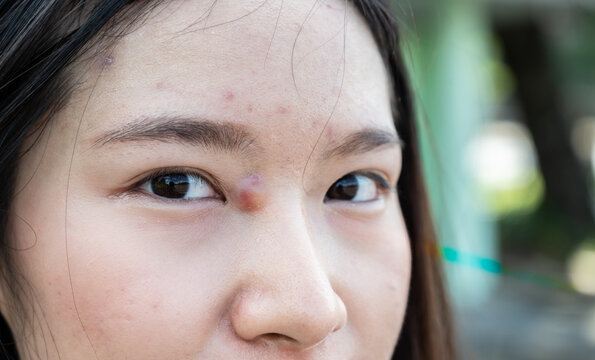 Close-up of Asian woman with pimple (or Elephant head acne) and acne inflamed on her face.