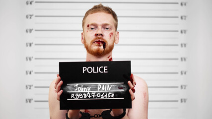 Young man with wounds on face holding signboard with cuffed hands posing for mugshot