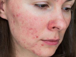 papulopustular rosacea, close-up of the patient's cheek