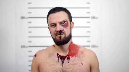 Arrested young beaten man posing for front view mugshot.