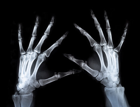 X-ray two hands fingers real scan